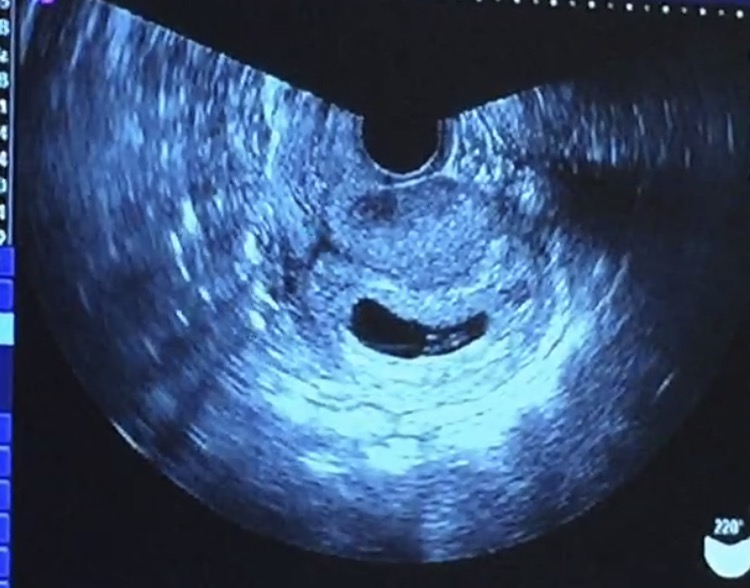 イメージカタログ トップ 妊娠初期 血の塊 妊娠継続